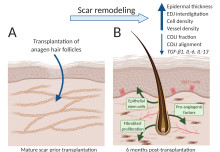 Scars mended using transplanted hair follicles in Imperial College London study